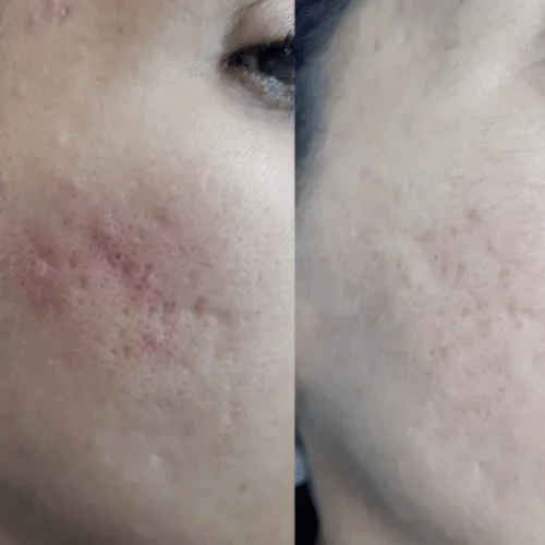 Transform ADVATX One