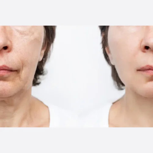 Transform ADVATX Three