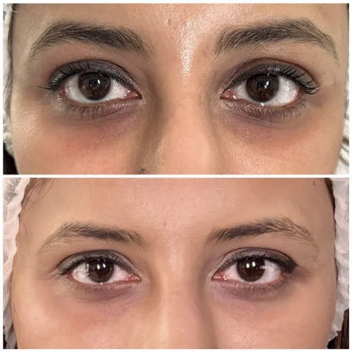 Transform ADVATX Two